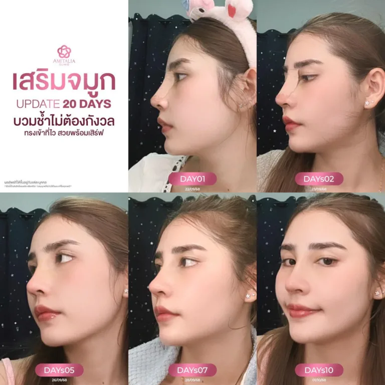 หลังเสริมจมูก