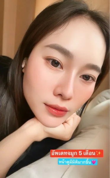 อัพเดทจมูก