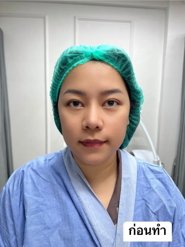 ตัดปีกจมูก