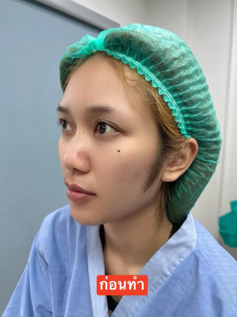 รีวิวจมูก