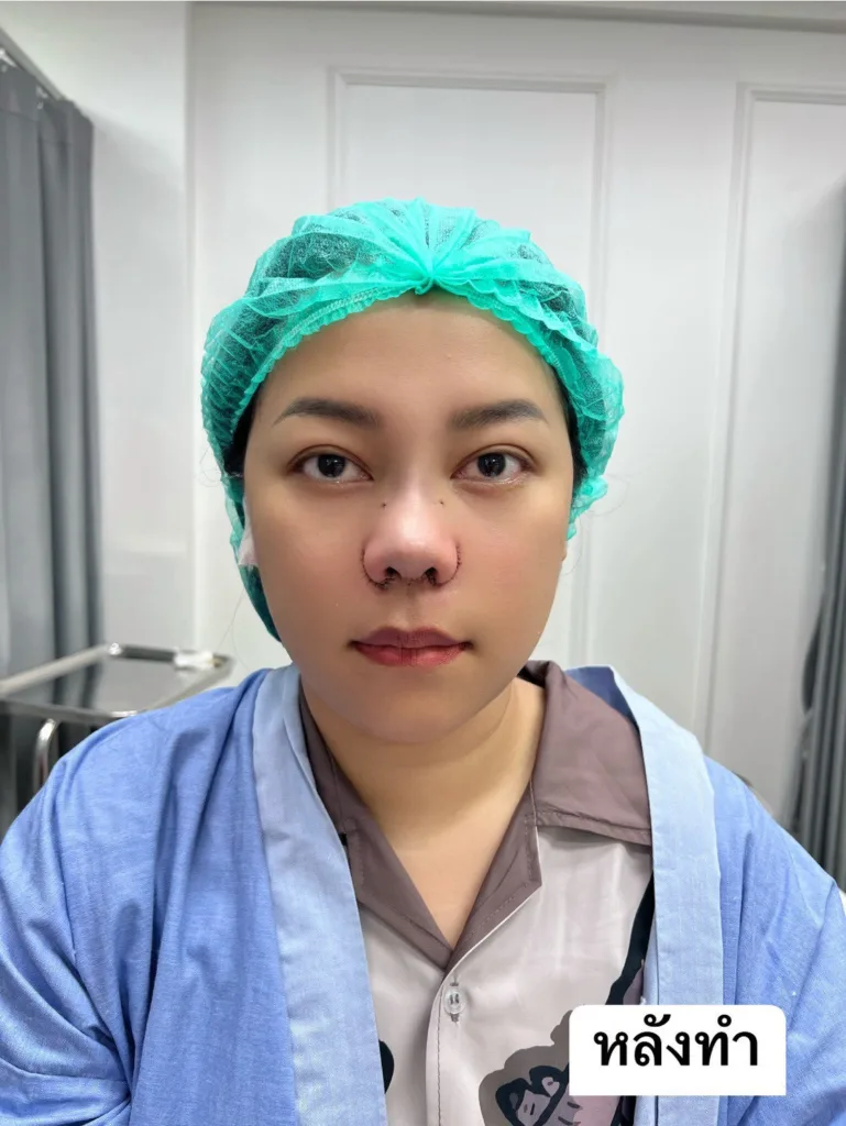 ตัดปีกจมูก