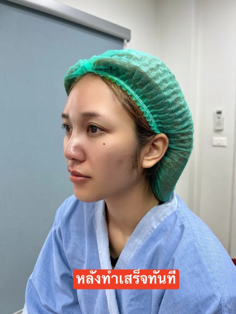 รีวิวจมูก