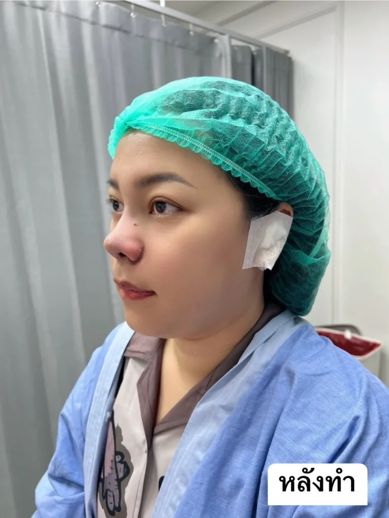 ตัดปีกจมูก