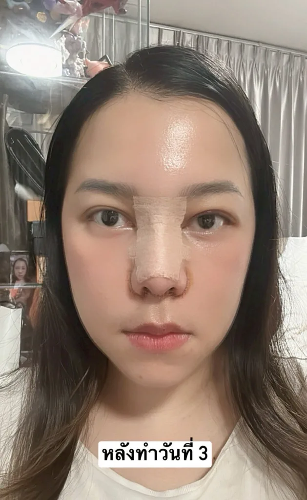 ตัดปีกจมูก