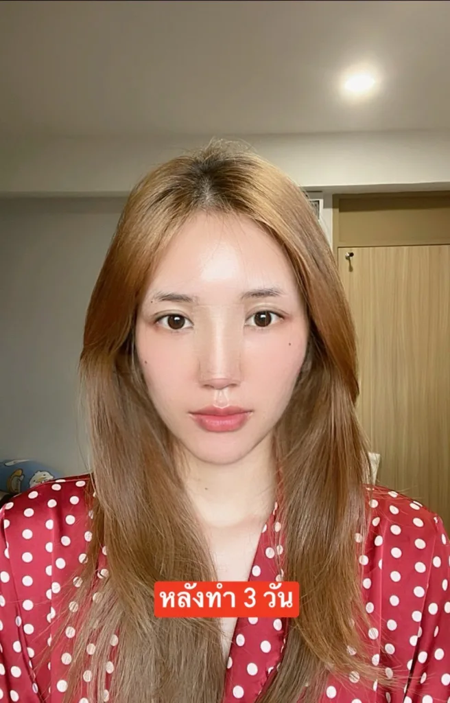 รีวิวจมูก