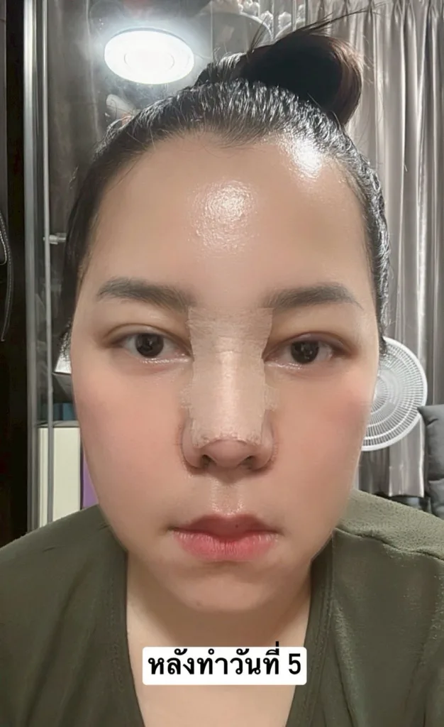 ตัดปีกจมูก