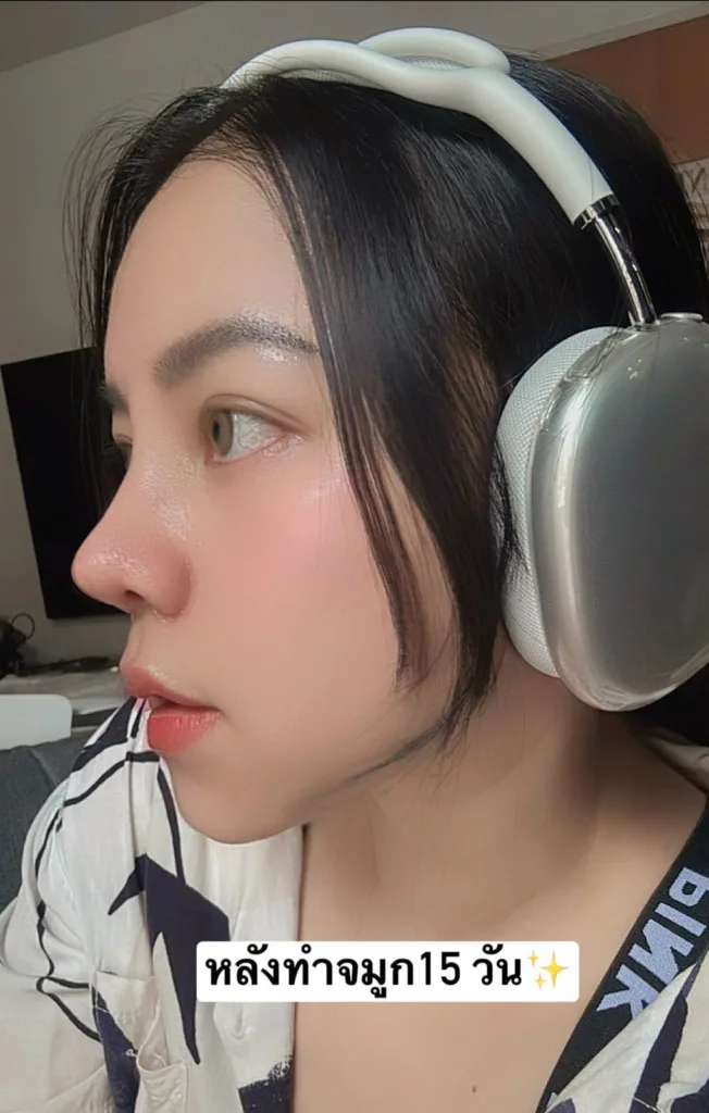 ตัดปีกจมูก