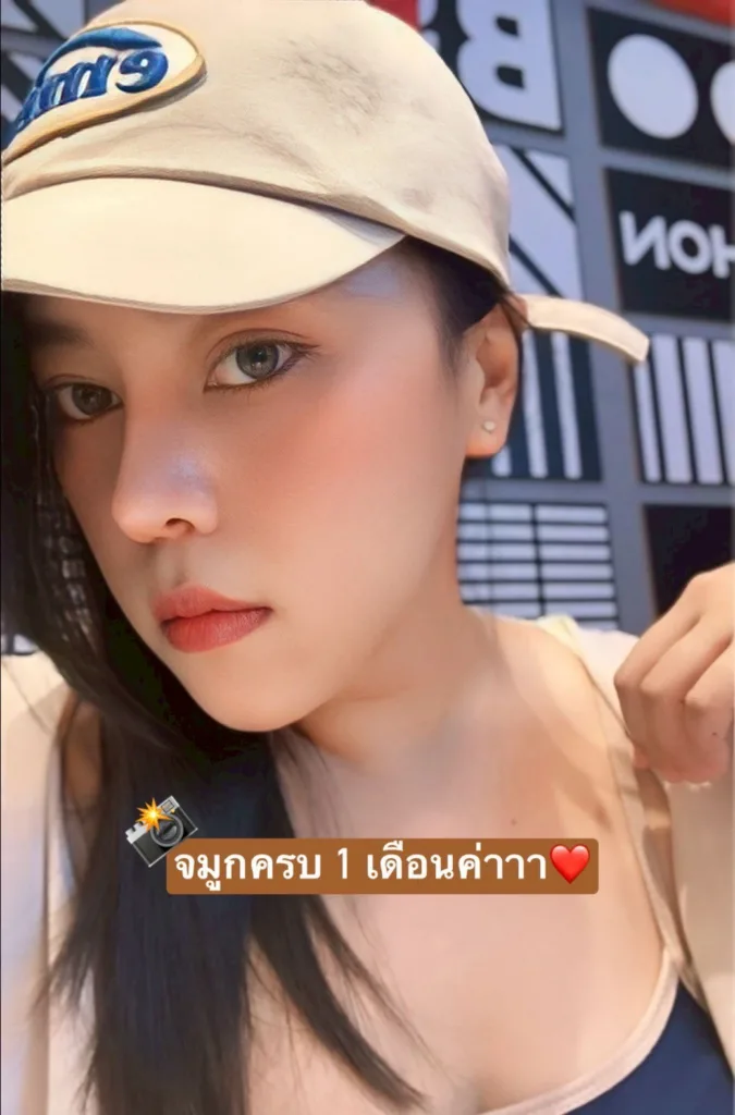 ตัดปีกจมูก