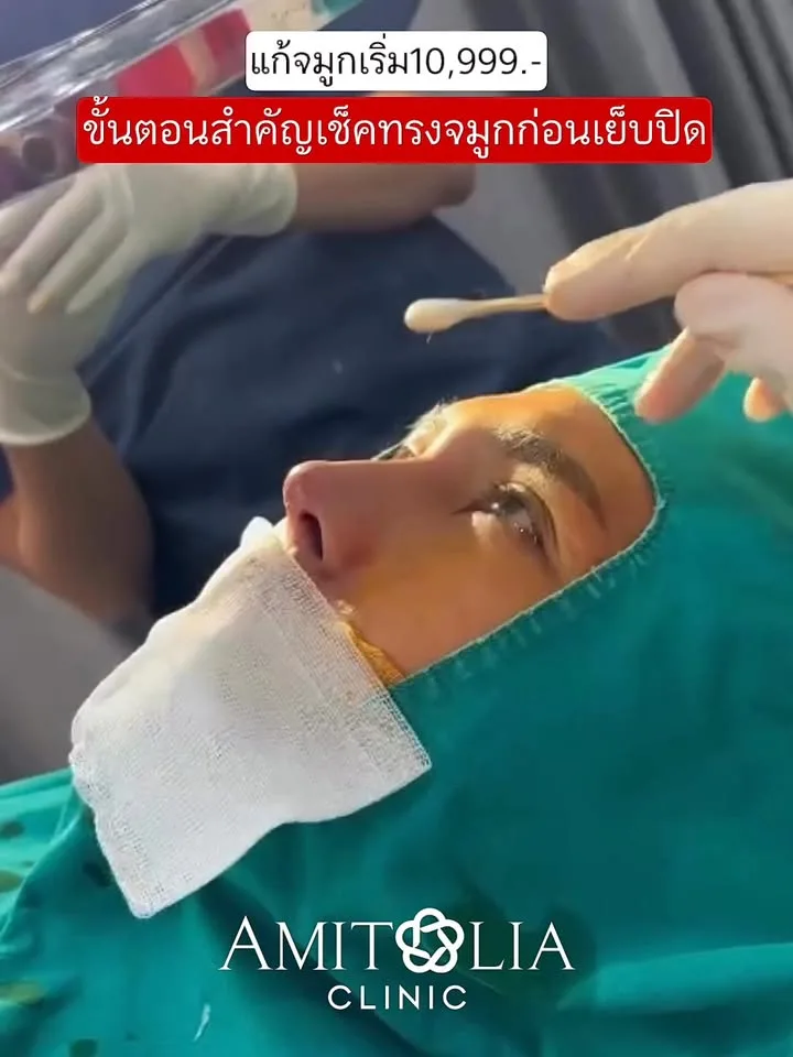 แก้จมูกทรงโด่ง