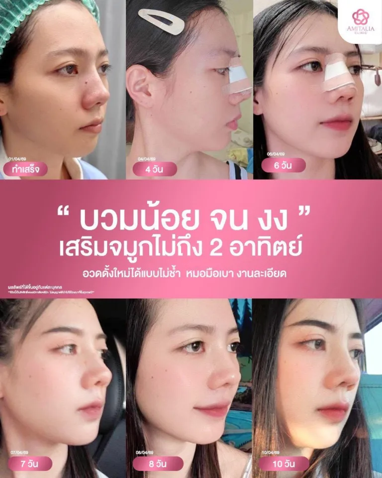 ดั้งใหม่