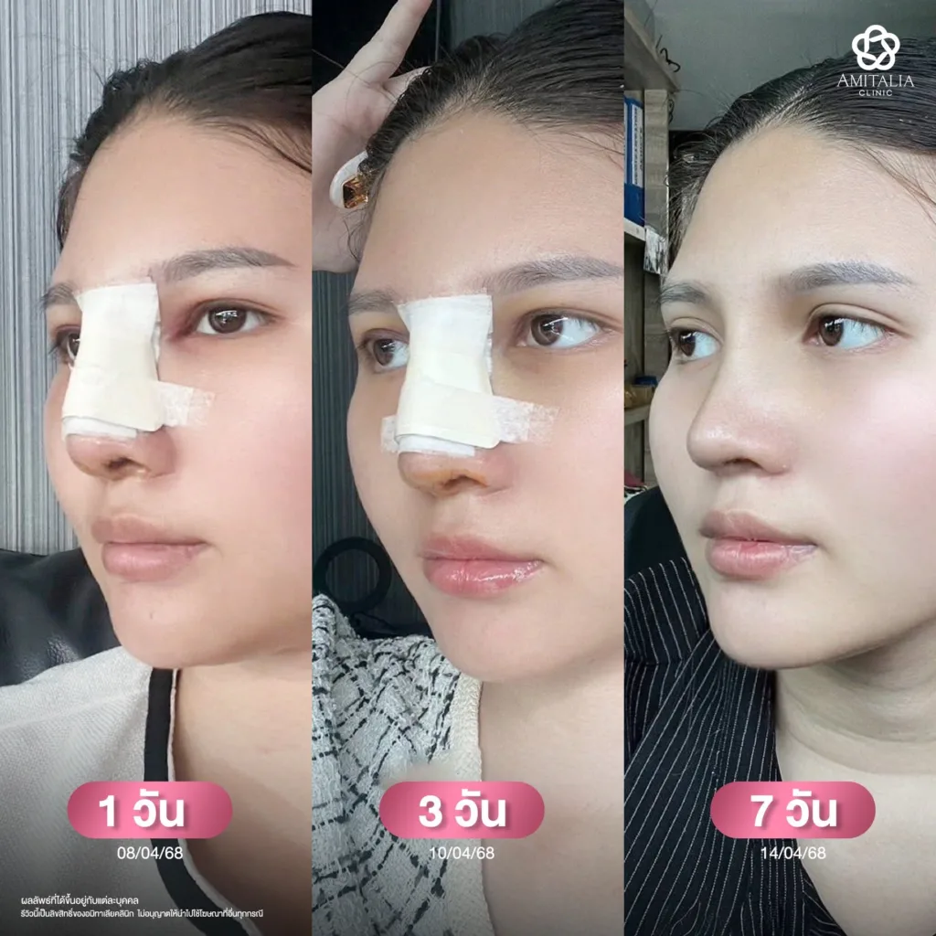 จมูกทรงสโลป
