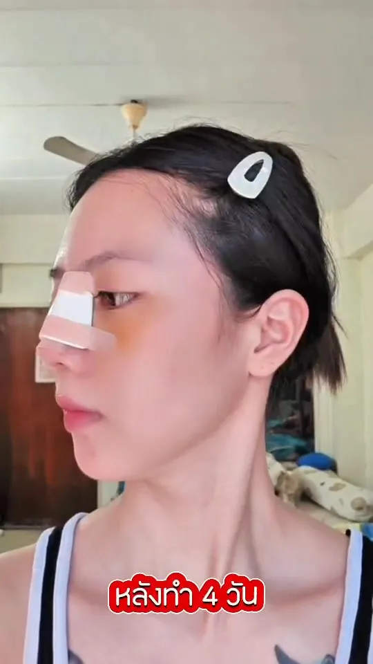 จมูกคด