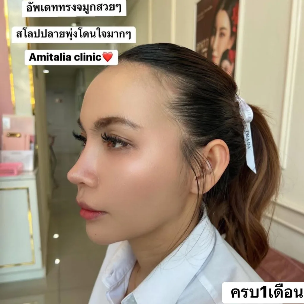 รีวิวแก้จมูกครบ 1เดือน
