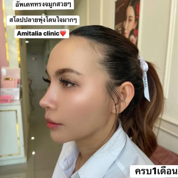 รีวิวแก้จมูกครบ 1เดือน
