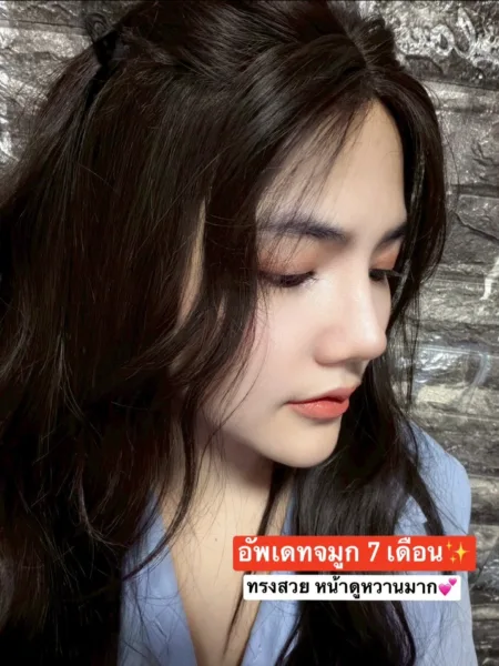 เสริมจมูกครั้งแรก