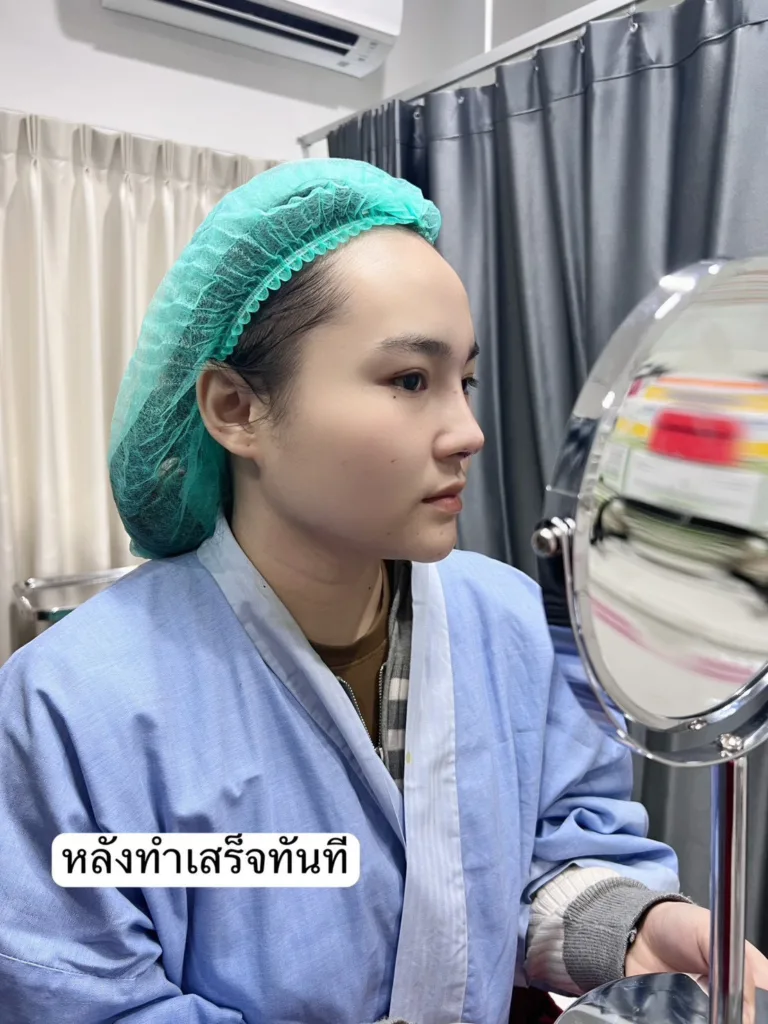 เสริมจมูกครั้งแรก