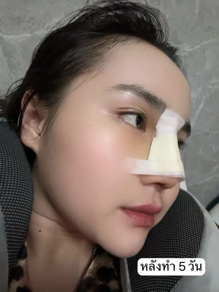 เสริมจมูกครั้งแรก
