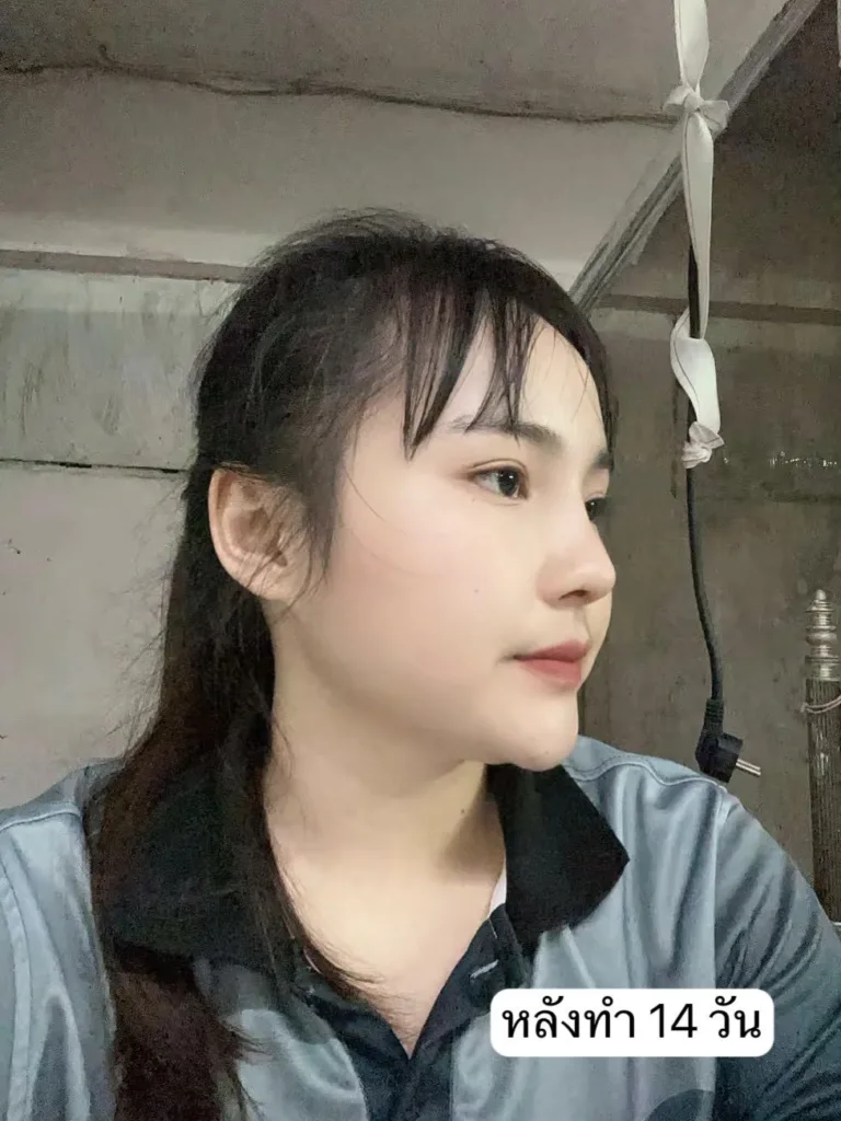 เสริมจมูกครั้งแรก