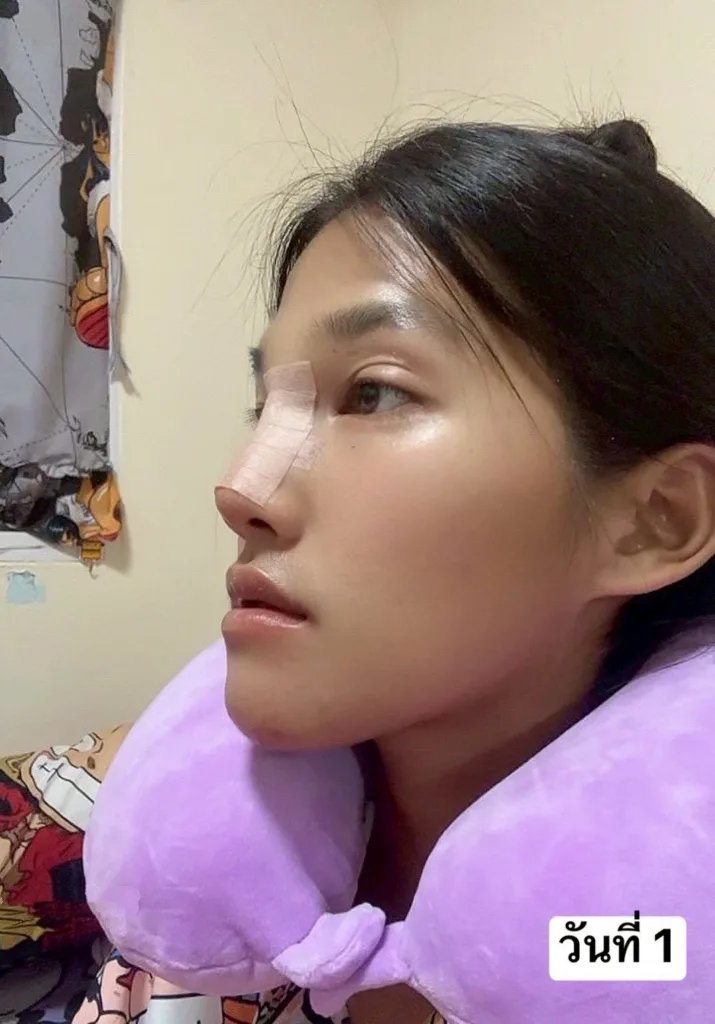 อัพเดทจมูก