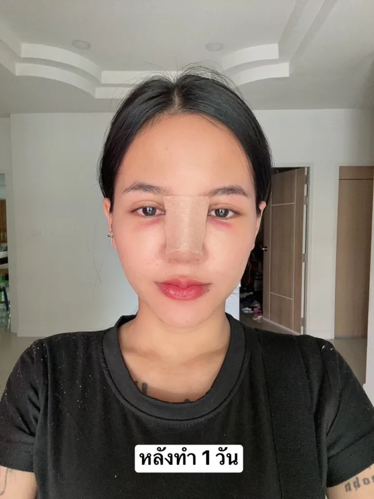 เสริมจมูก