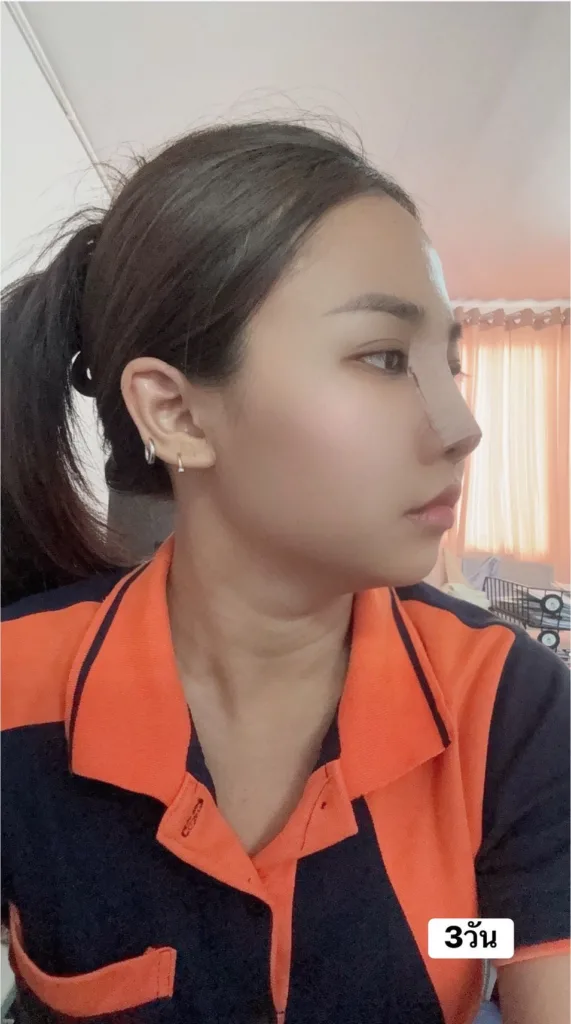 จมูกลอย