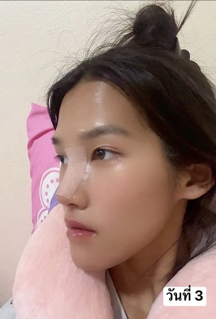 อัพเดทจมูก
