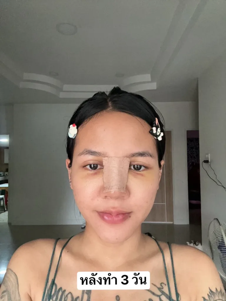 เสริมจมูก