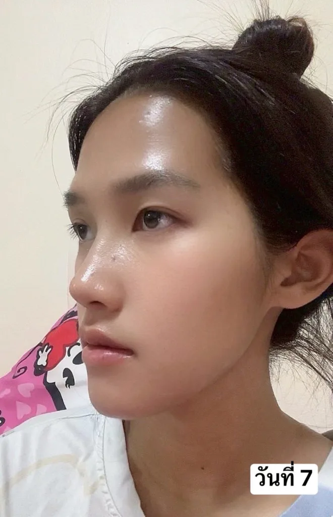 อัพเดทจมูก
