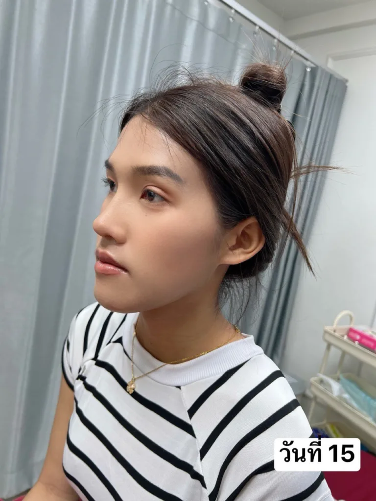 อัพเดทจมูก
