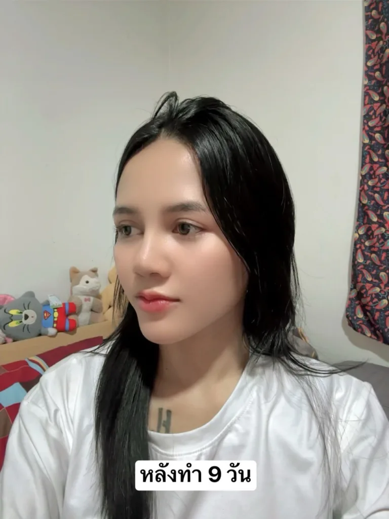 เสริมจมูก