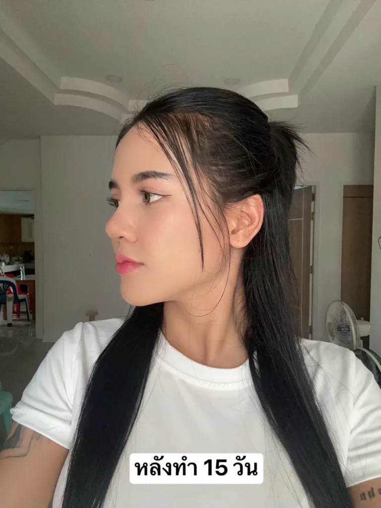 เสริมจมูก