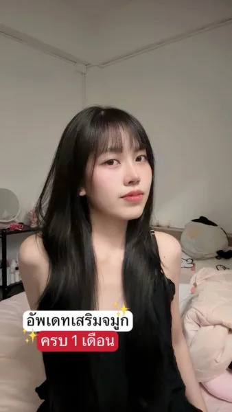 เสริมจมูก