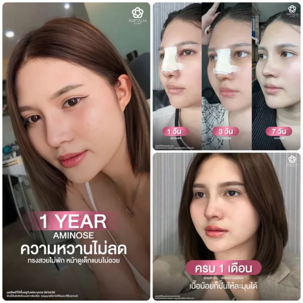 จมูกทรงสโลป