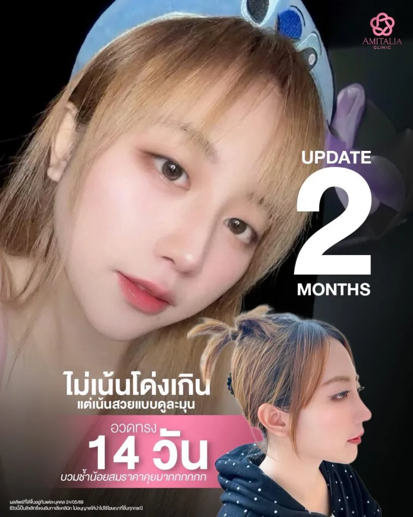 ทรงจมูกล่าสุด