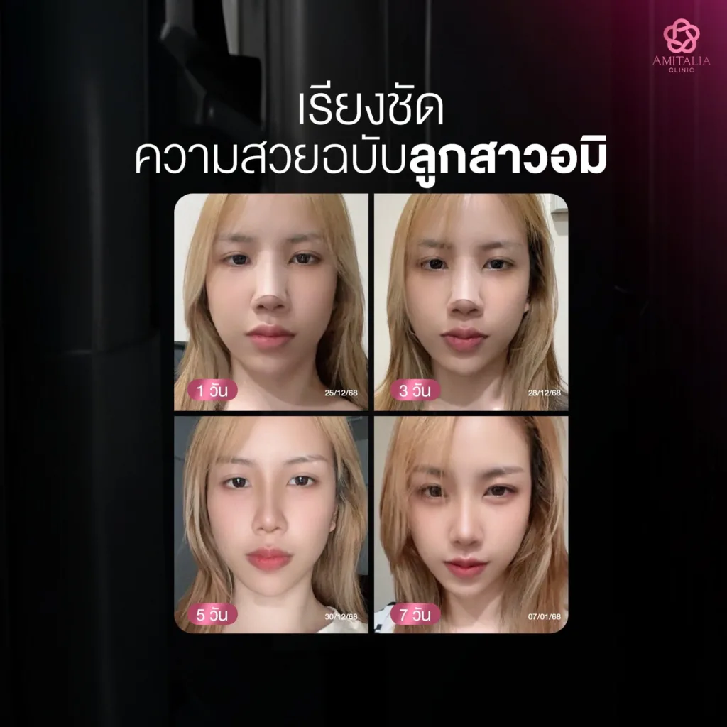 UPDATE จมูก