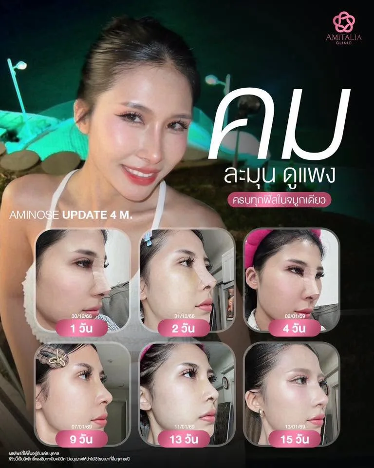 ทรงจมูก