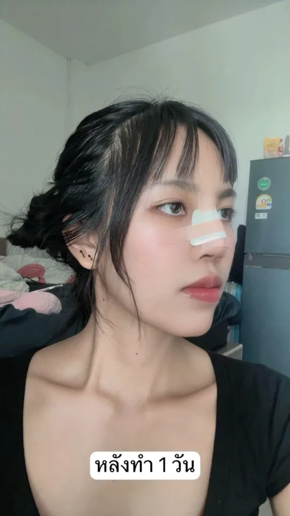 เสริมจมูกใหม่