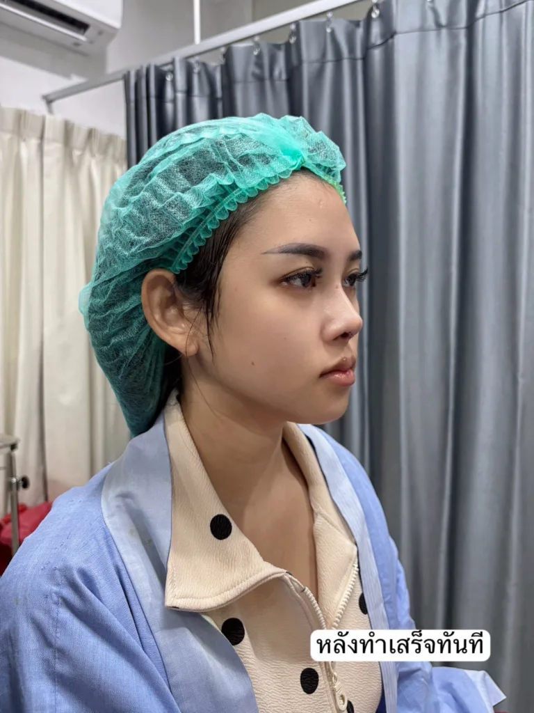 เสริมจมูกครั้งแรก