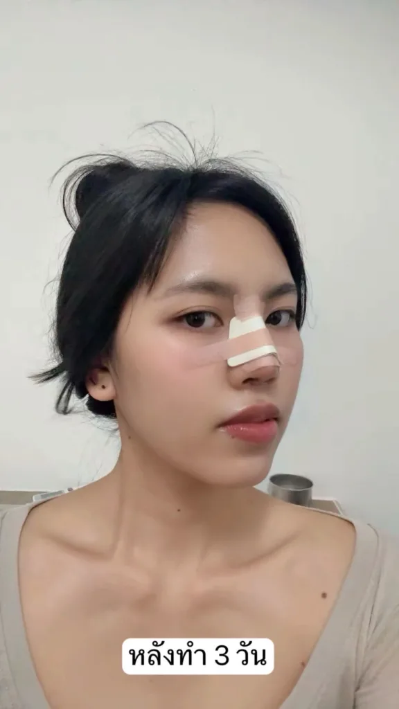 เสริมจมูกใหม่