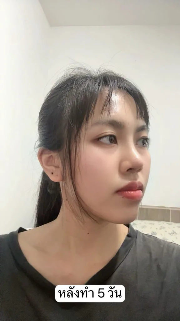 เสริมจมูกใหม่