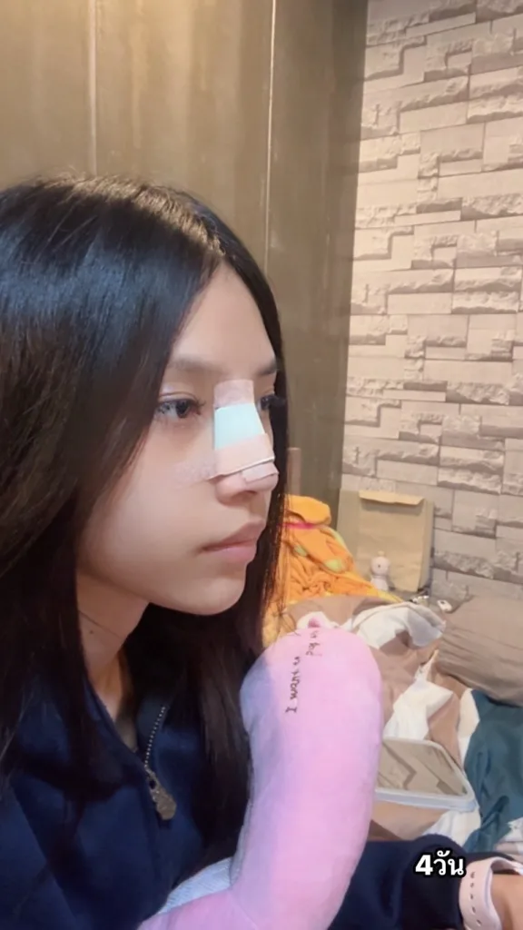 อัพเดททรงจมูก