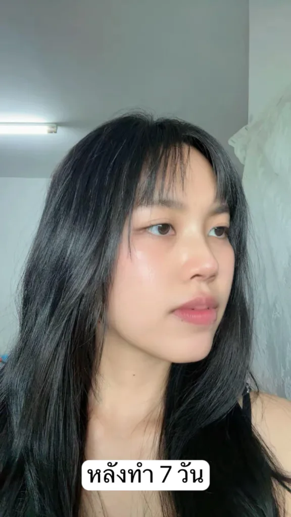 เสริมจมูกใหม่