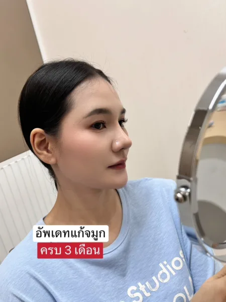 แก้จมูก