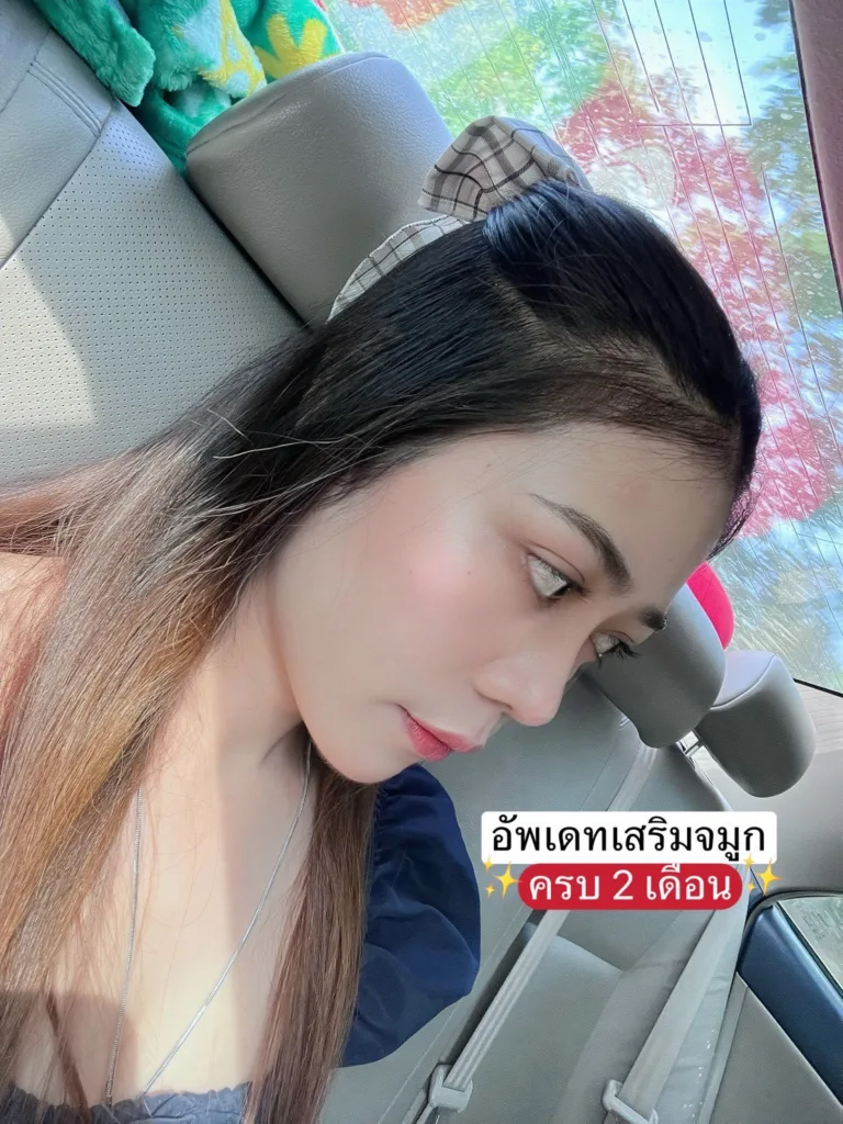เสริมจมูกครั้งแรก