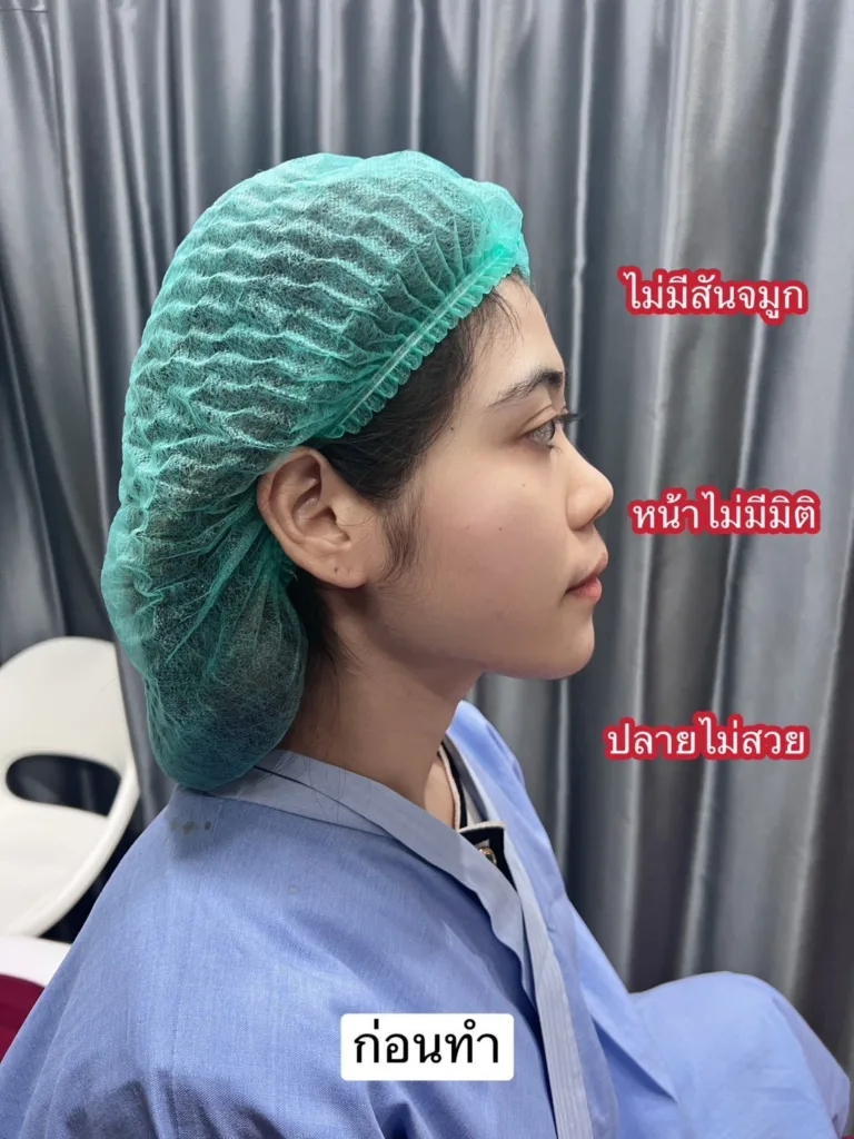 เสริมจมูกครั้งแรก