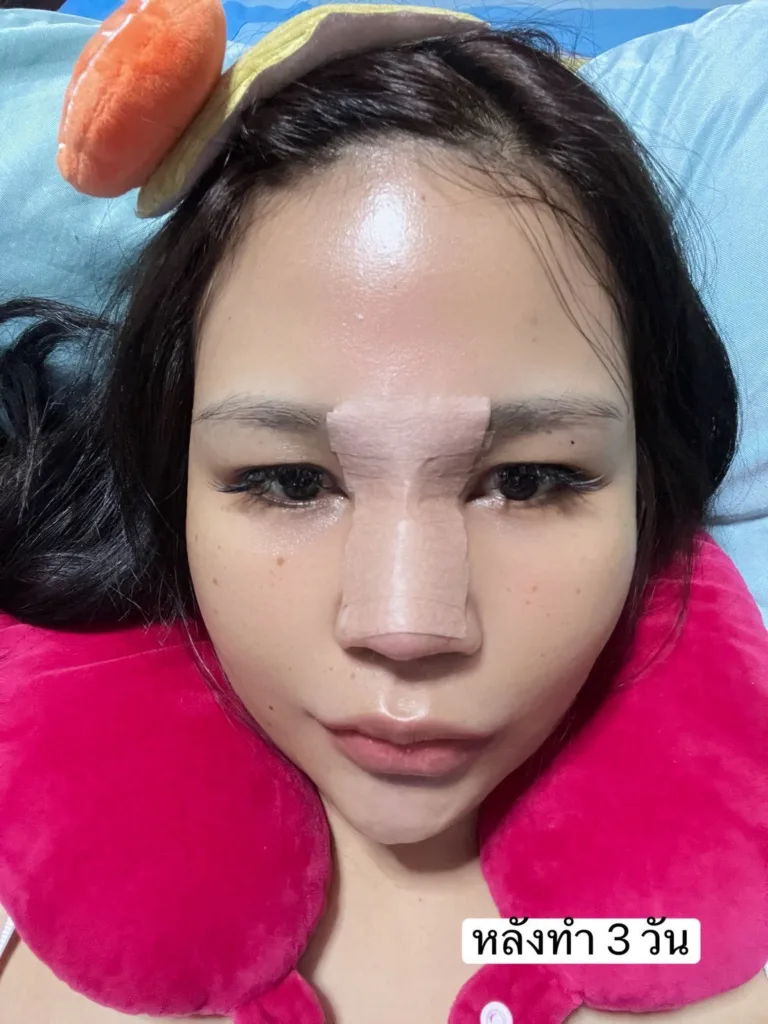 อัพเดทแก้จมูก