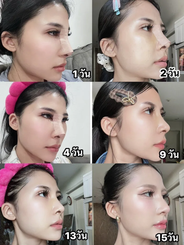 เสริมจมูก