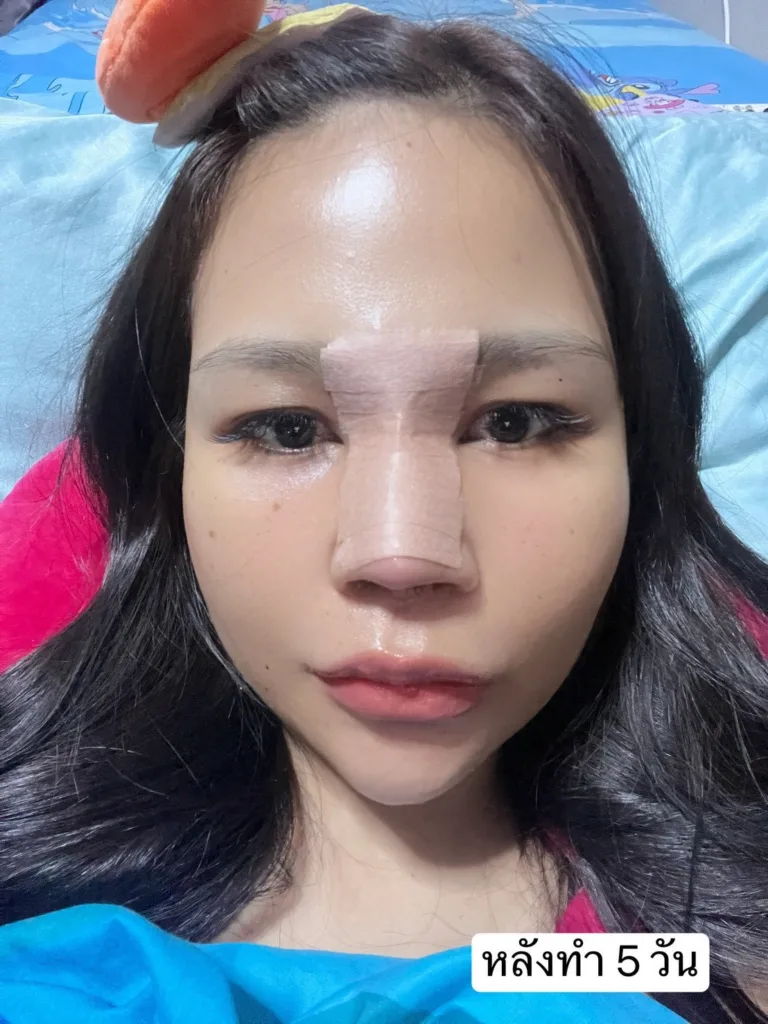 อัพเดทแก้จมูก