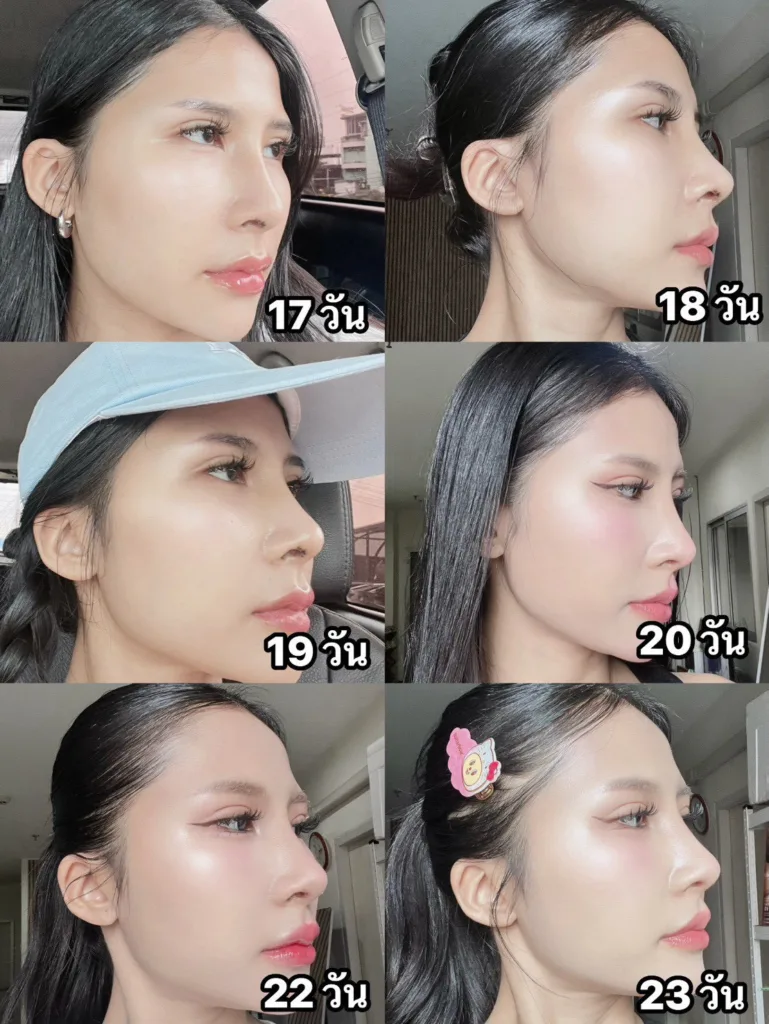 เสริมจมูก