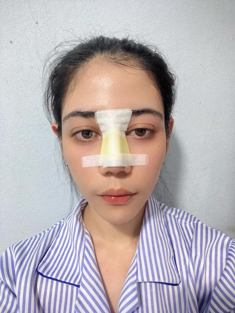 เสริมจมูกครั้งแรก